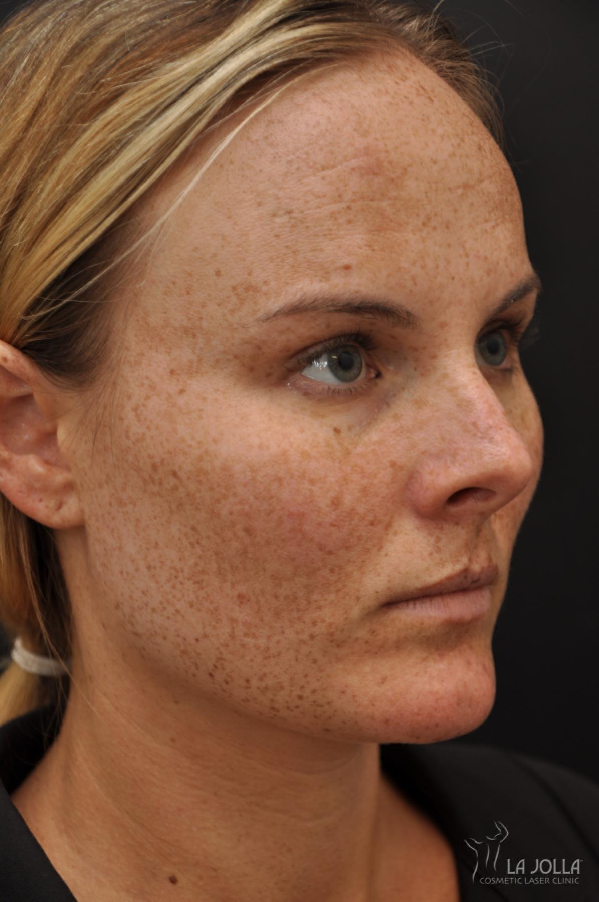 Chemical Peel: Patient 10 - Before and After 3