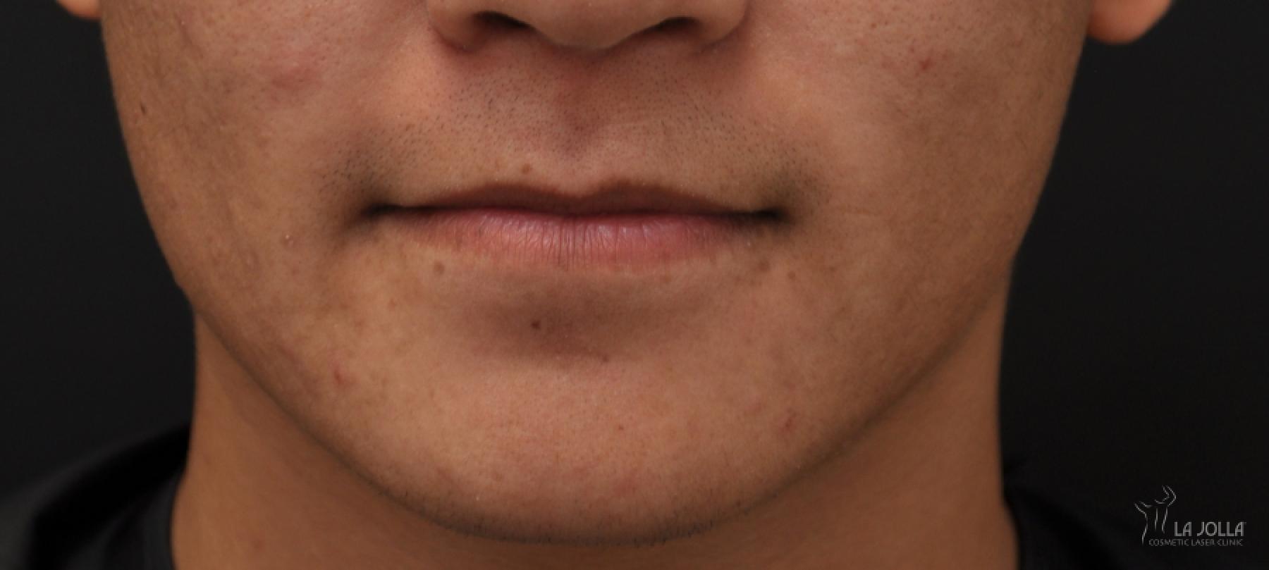 Lip Filler: Patient 10 - Before 1