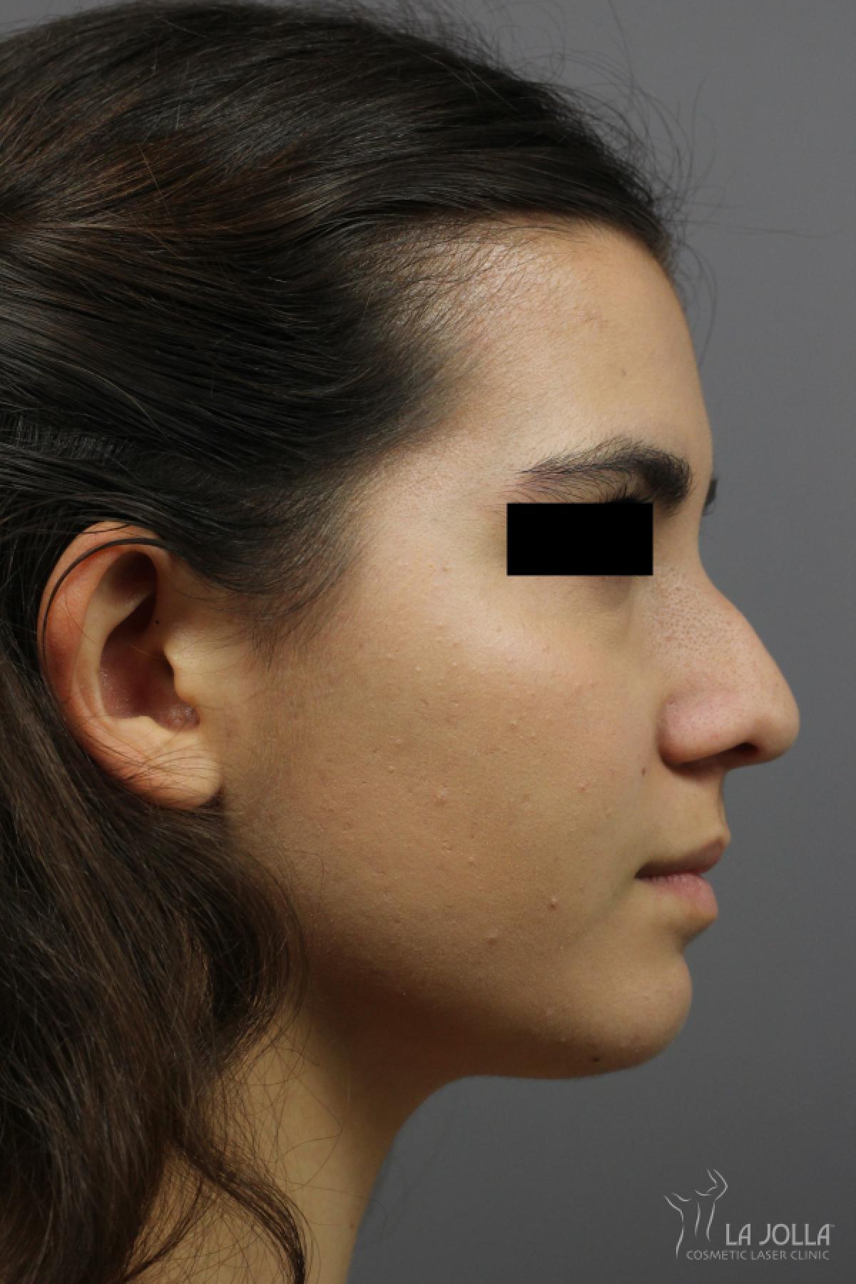 Non-Surgical Nose Job: Patient 2 - Before 1