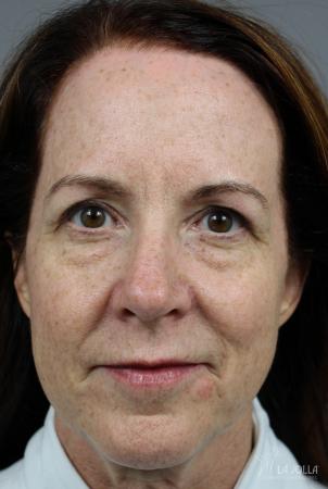 Sculptra®: Patient 2 - Before 