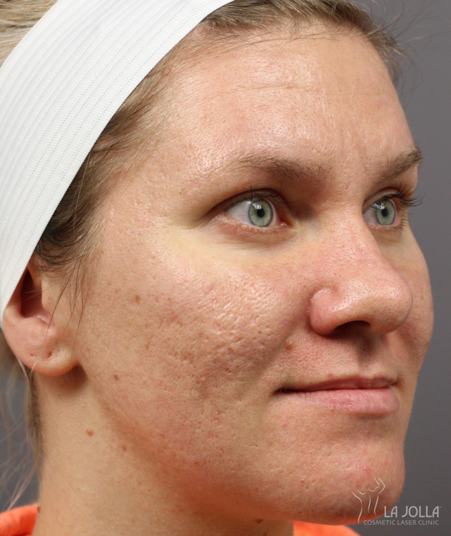 Lip Filler: Patient 16 - Before 1