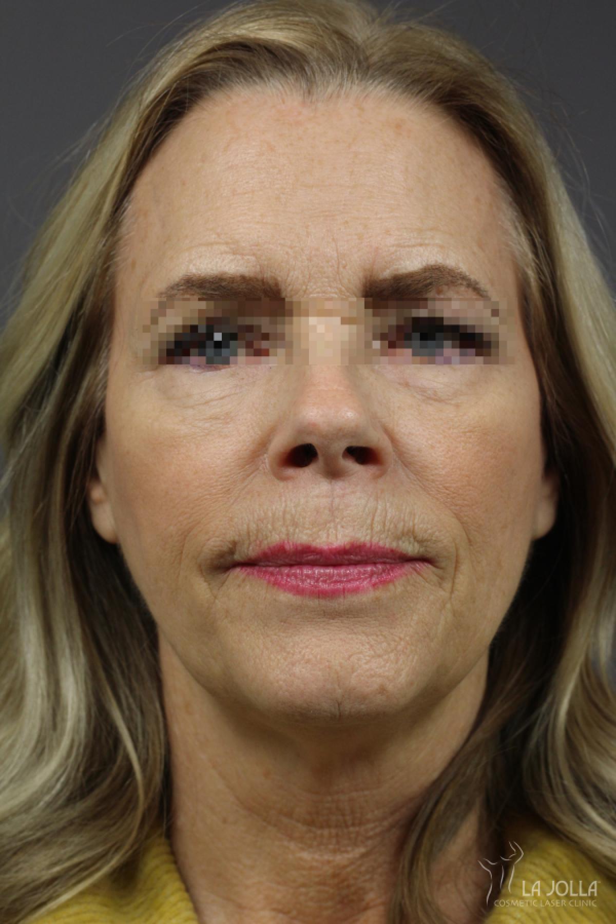 CO2 Laser: Patient 17 - Before 1