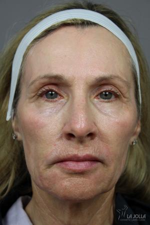 Liquid Facelift: Patient 3 - Before 