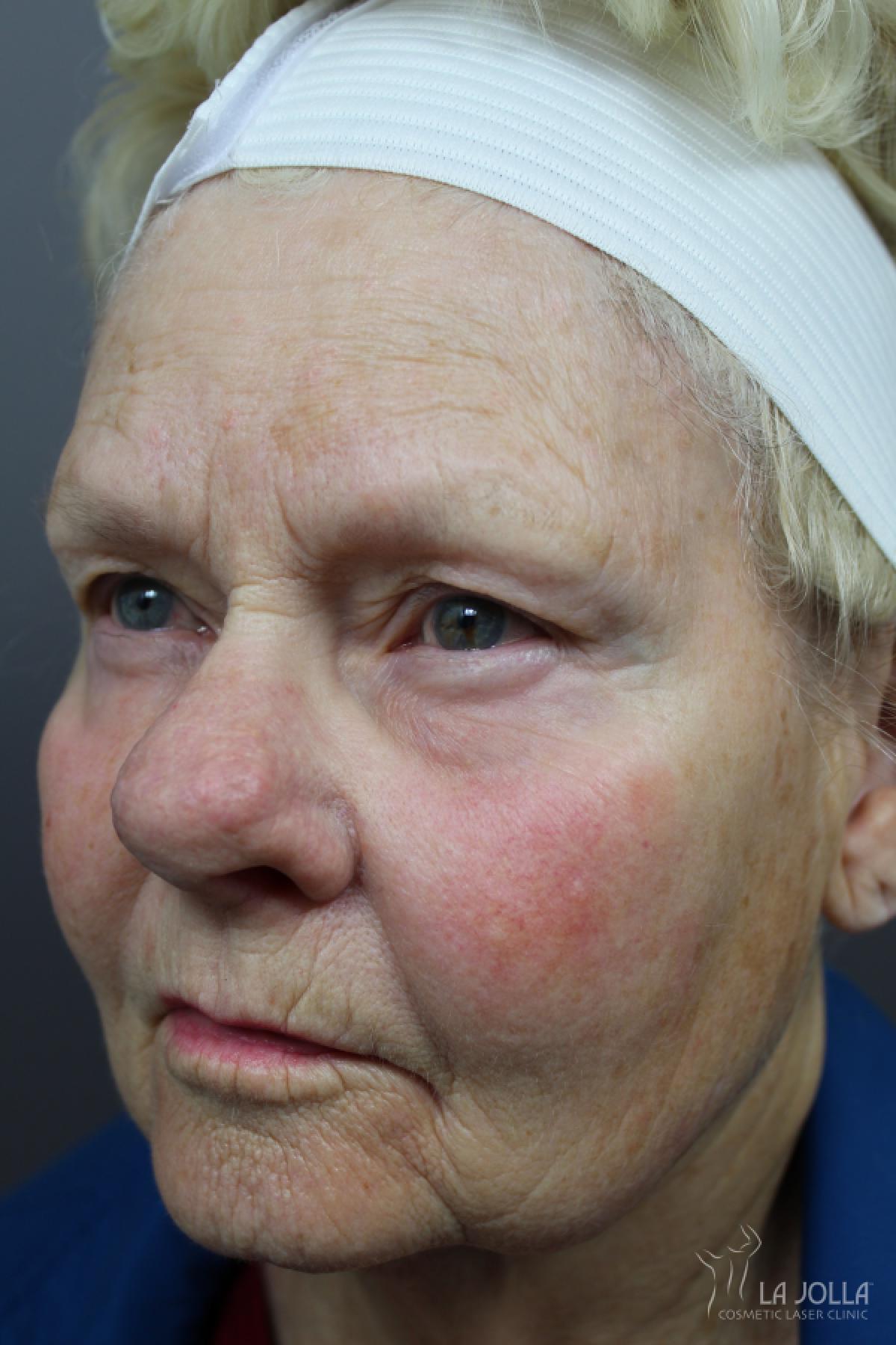 Lasers For Rhinophyma: Patient 2 - Before and After 2