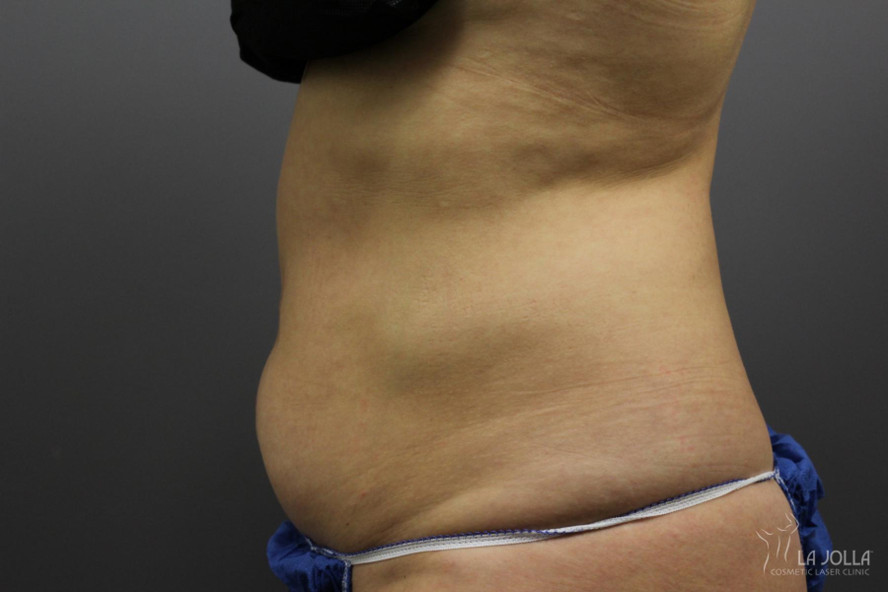 CoolSculpting®: Patient 6 - Before and After 2