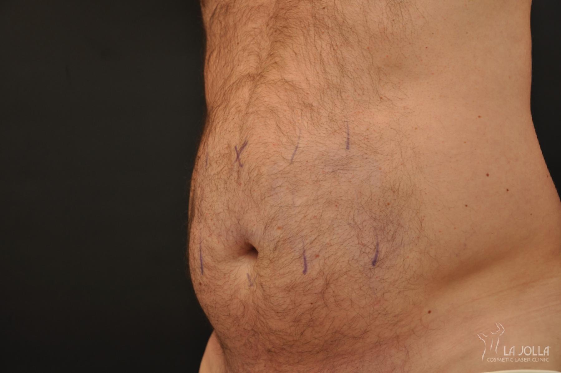 CoolSculpting®: Patient 11 - Before 1