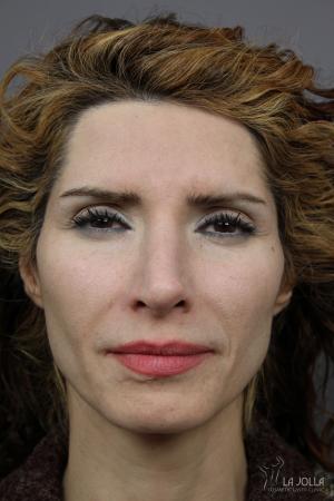 Liquid Facelift: Patient 5 - Before 