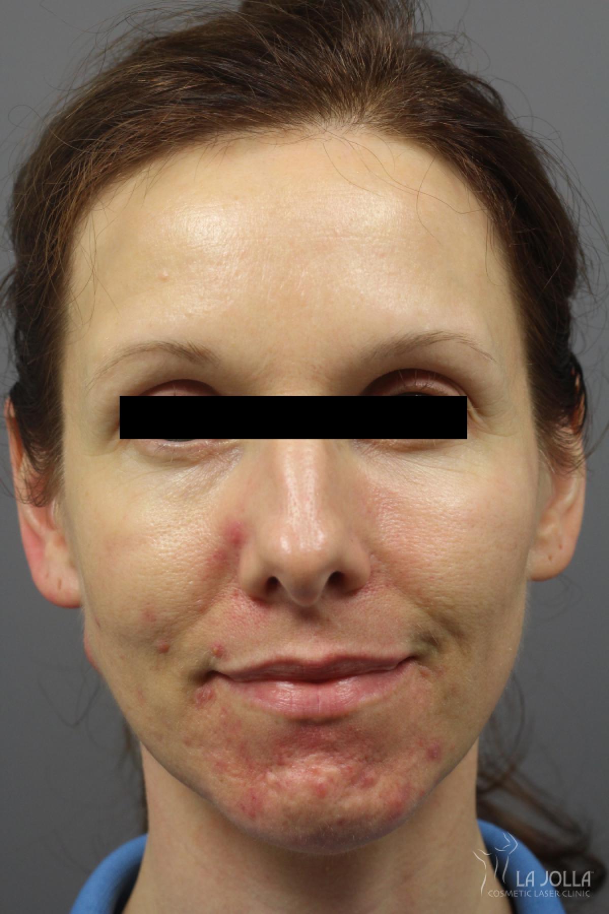 Acne Rejuvenation: Patient 3 - Before 1