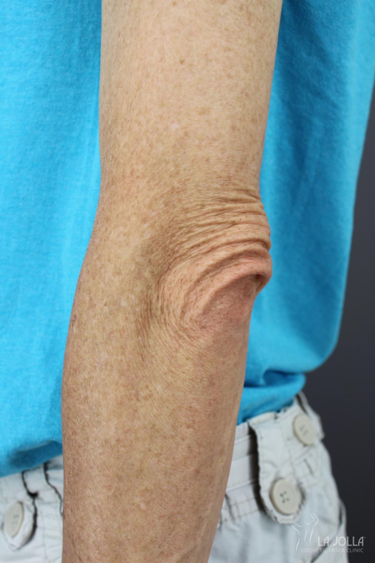 StarWalker® Laser: Patient 10 - Before 