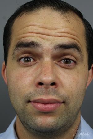 BOTOX® Cosmetic: Patient 2 - Before 