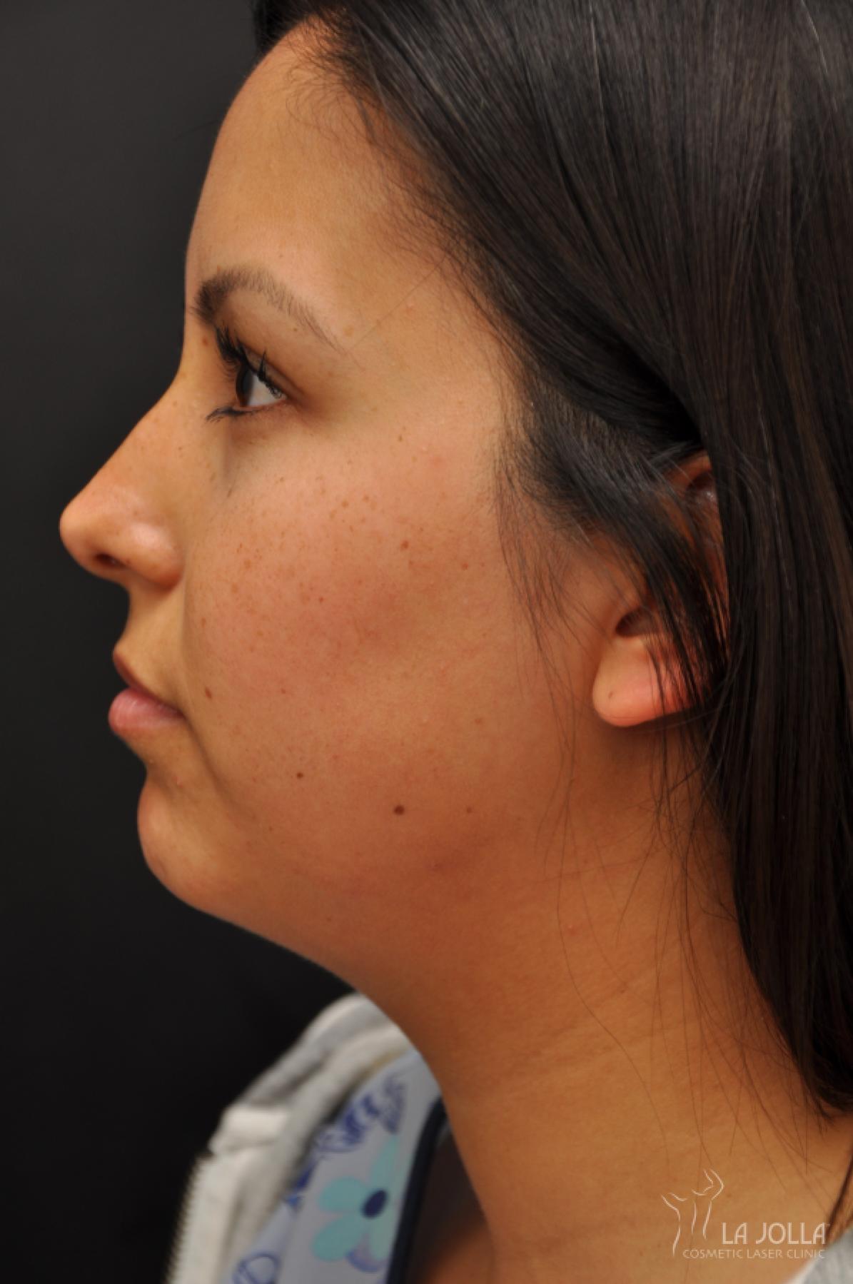 Kybella: Patient 5 - Before 