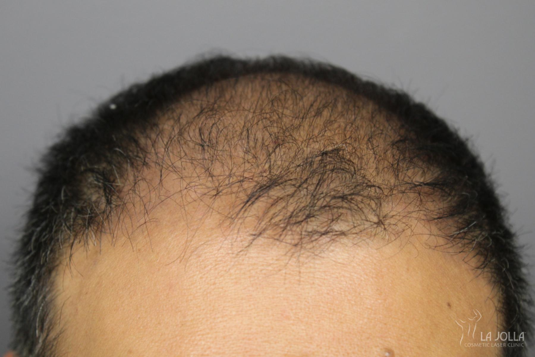 Hair Restoration: Patient 3 - Before 