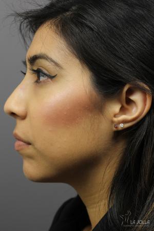 Non-Surgical Nose Job: Patient 4 - After  