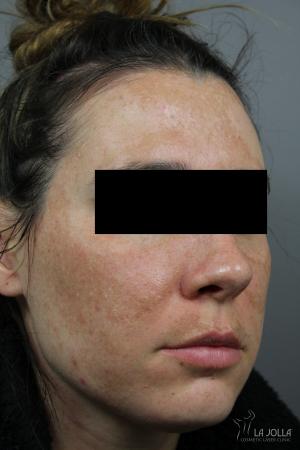 Chemical Peel: Patient 7 - Before and After 2