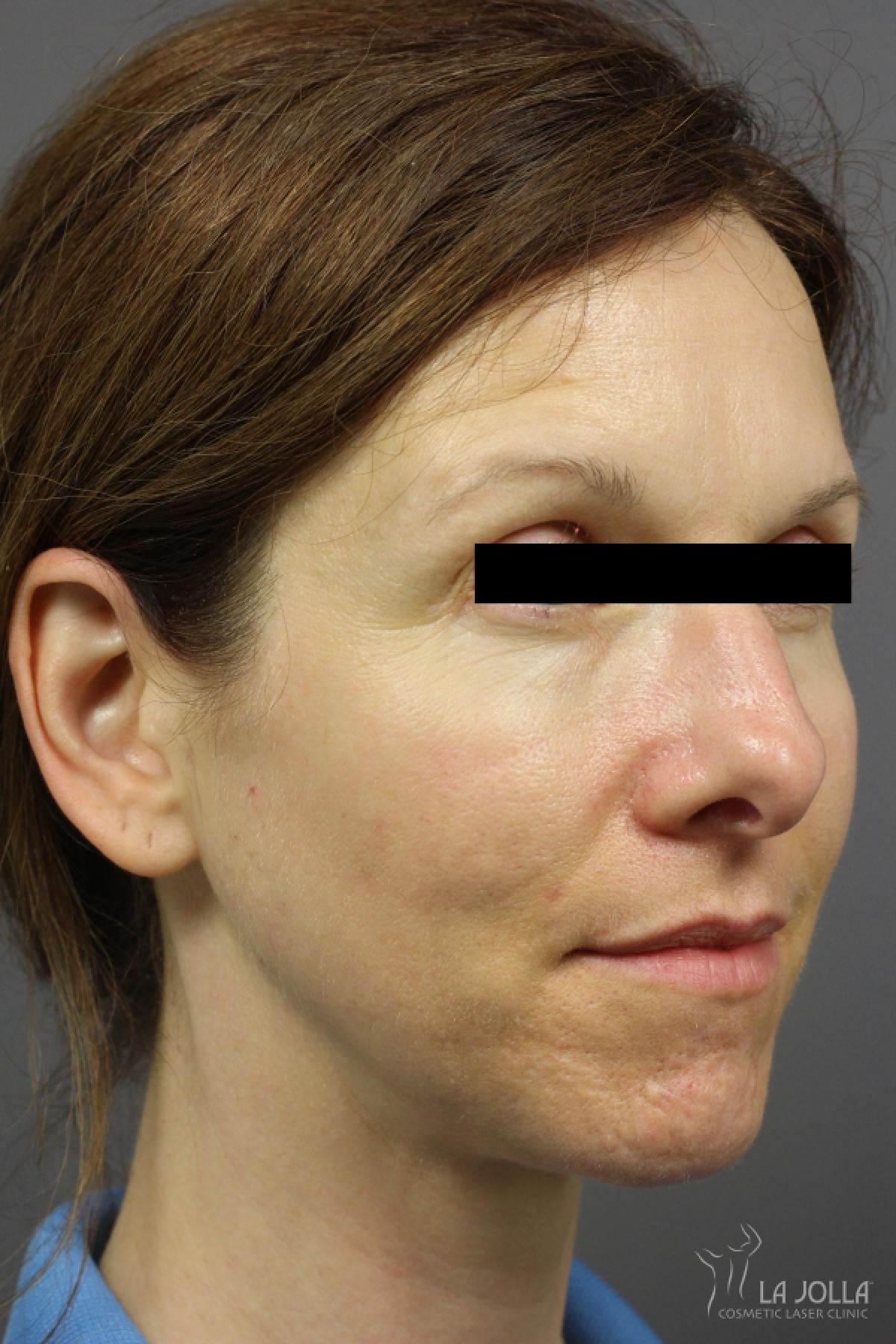 Acne Rejuvenation: Patient 3 - After 2