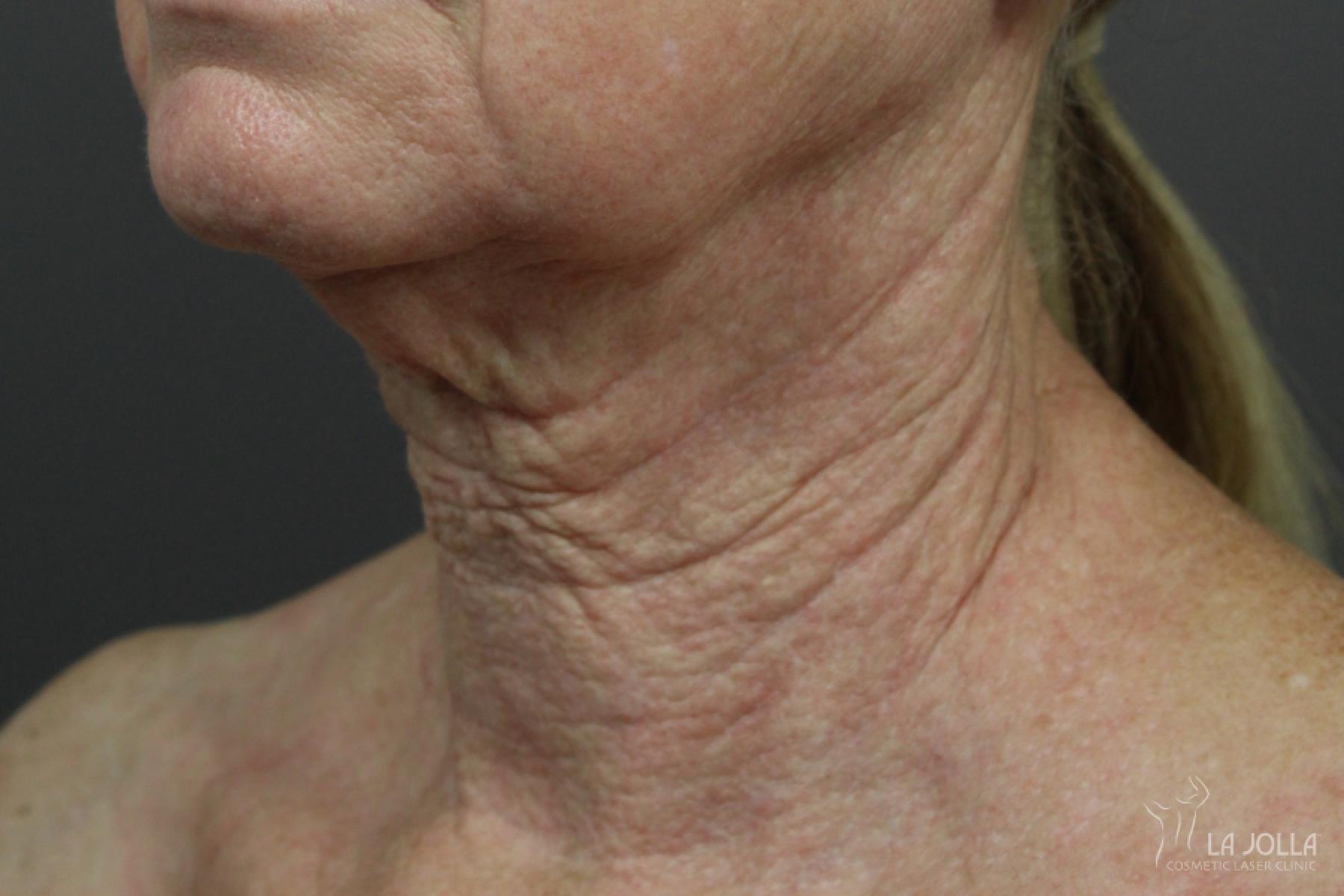 Non-Surgical Necklift: Patient 2 - After  