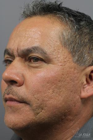Acne Scars: Patient 6 - Before 