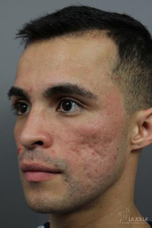 Acne Scars: Patient 4 - After  