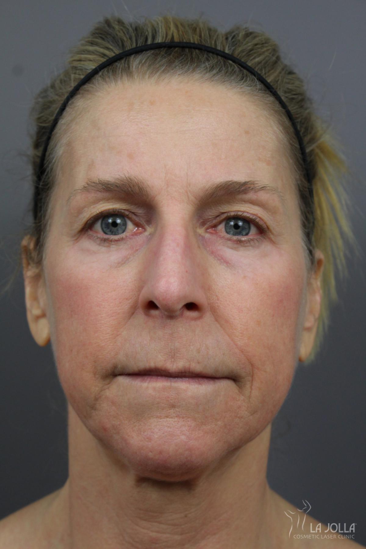 CO2 Laser: Patient 16 - Before 1