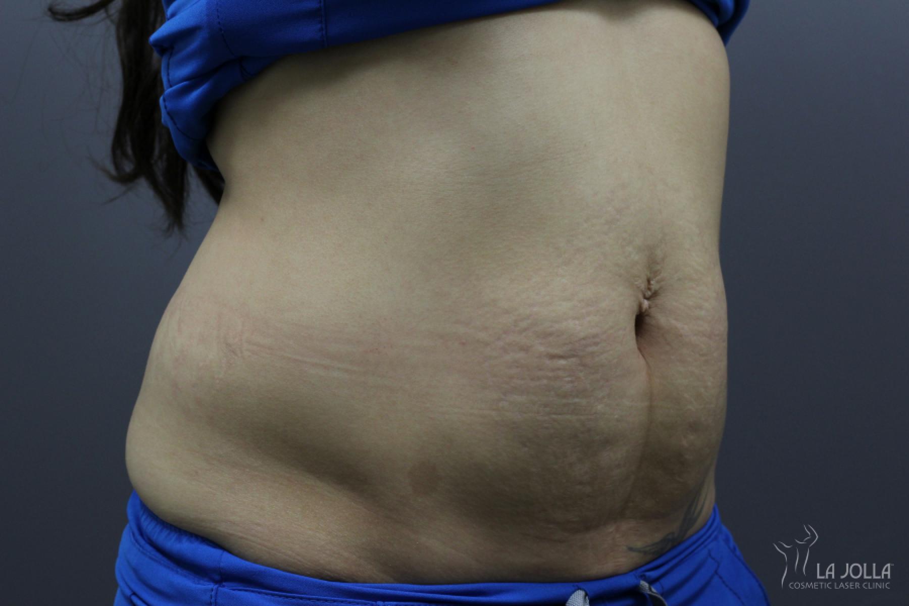 StarWalker® Laser: Patient 8 - Before 