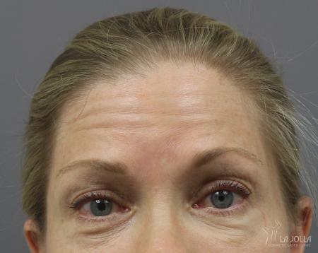 BOTOX® Cosmetic: Patient 4 - Before 