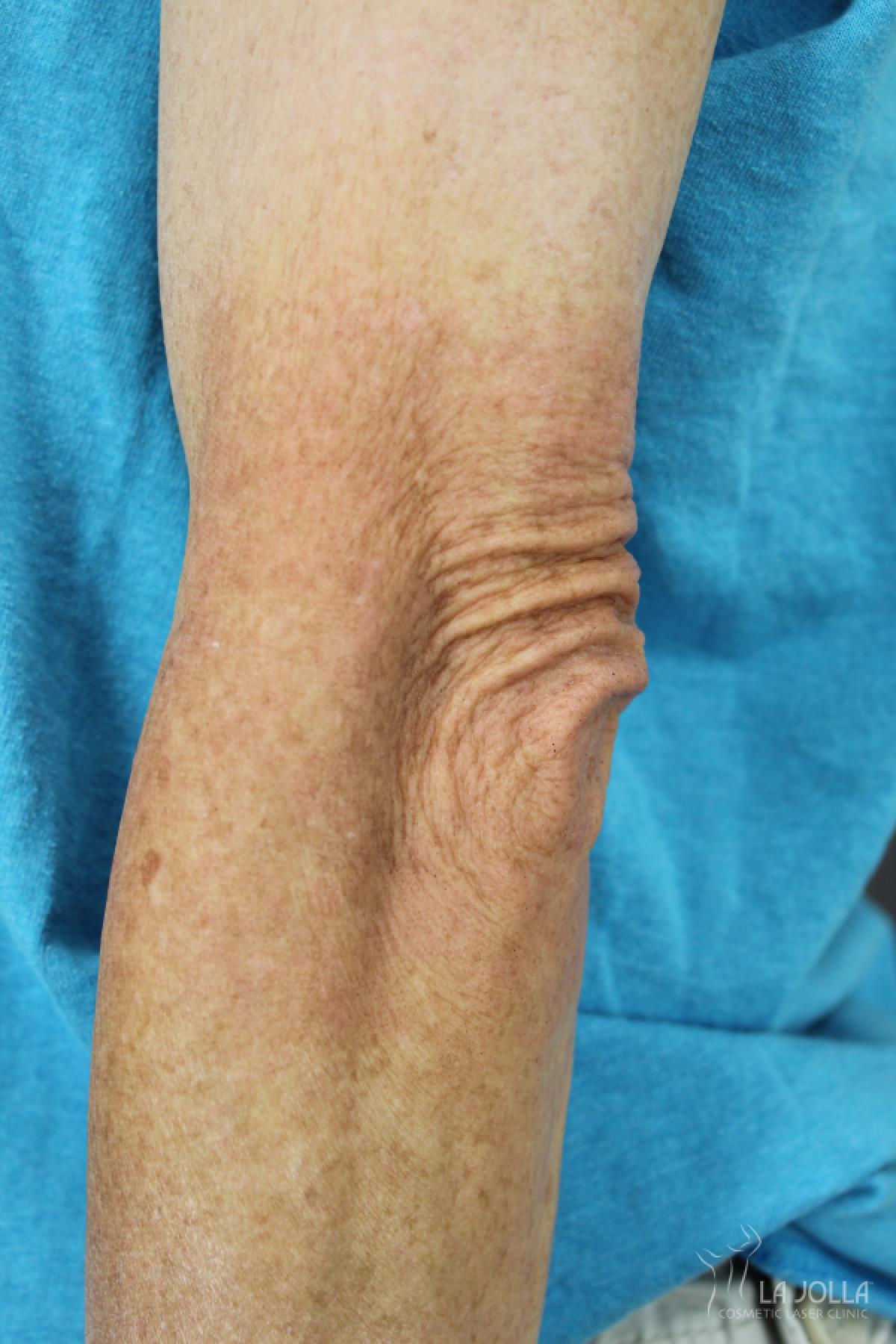 StarWalker® Laser: Patient 10 - After  