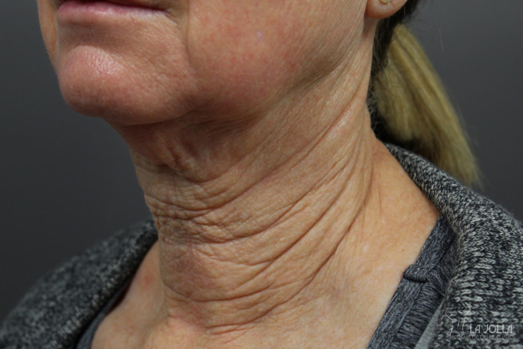 Non-Surgical Necklift: Patient 2 - Before 1