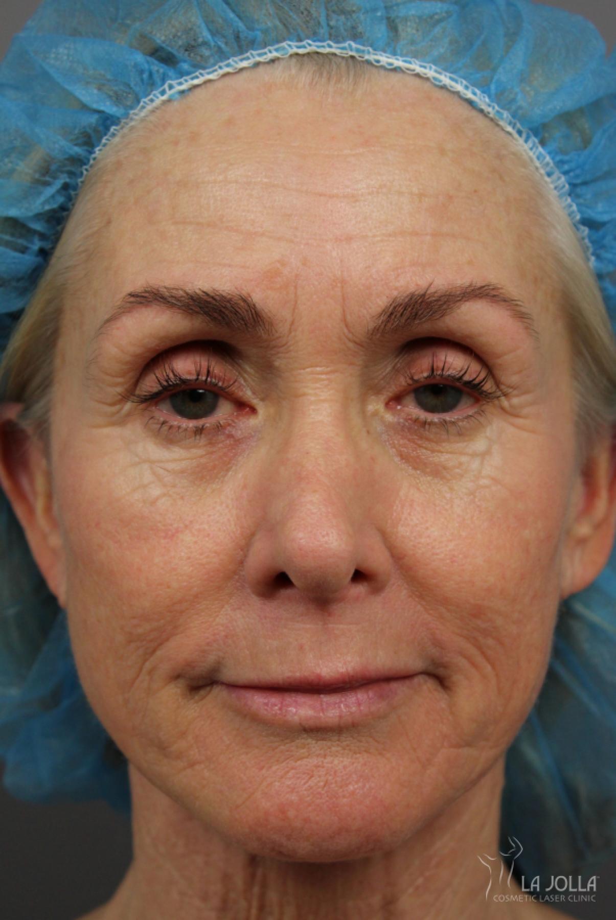 Laser Skin Resurfacing: Patient 1 - Before 