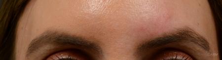 Fraxel®: Patient 10 - After  