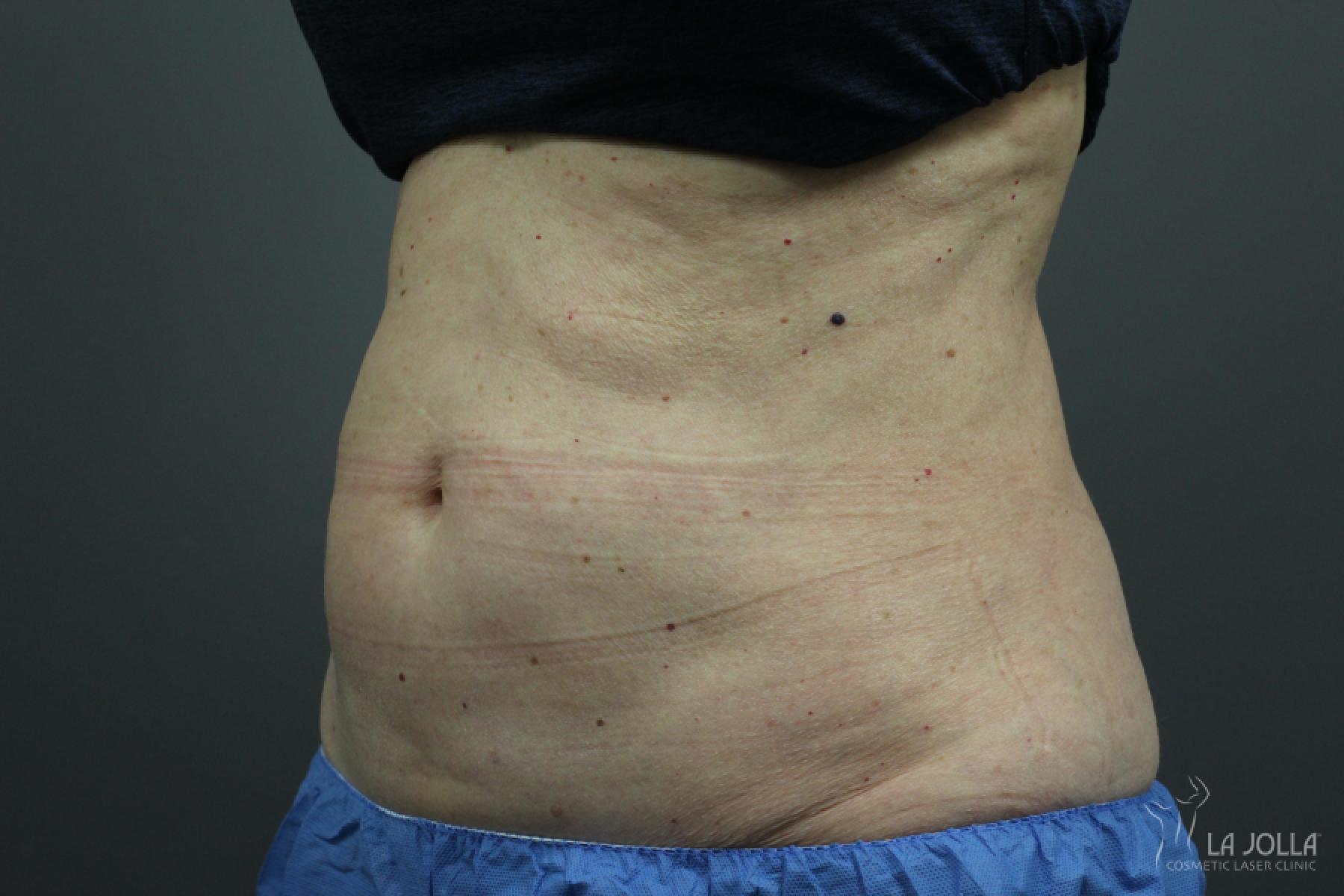 CoolSculpting®: Patient 11 - After 1