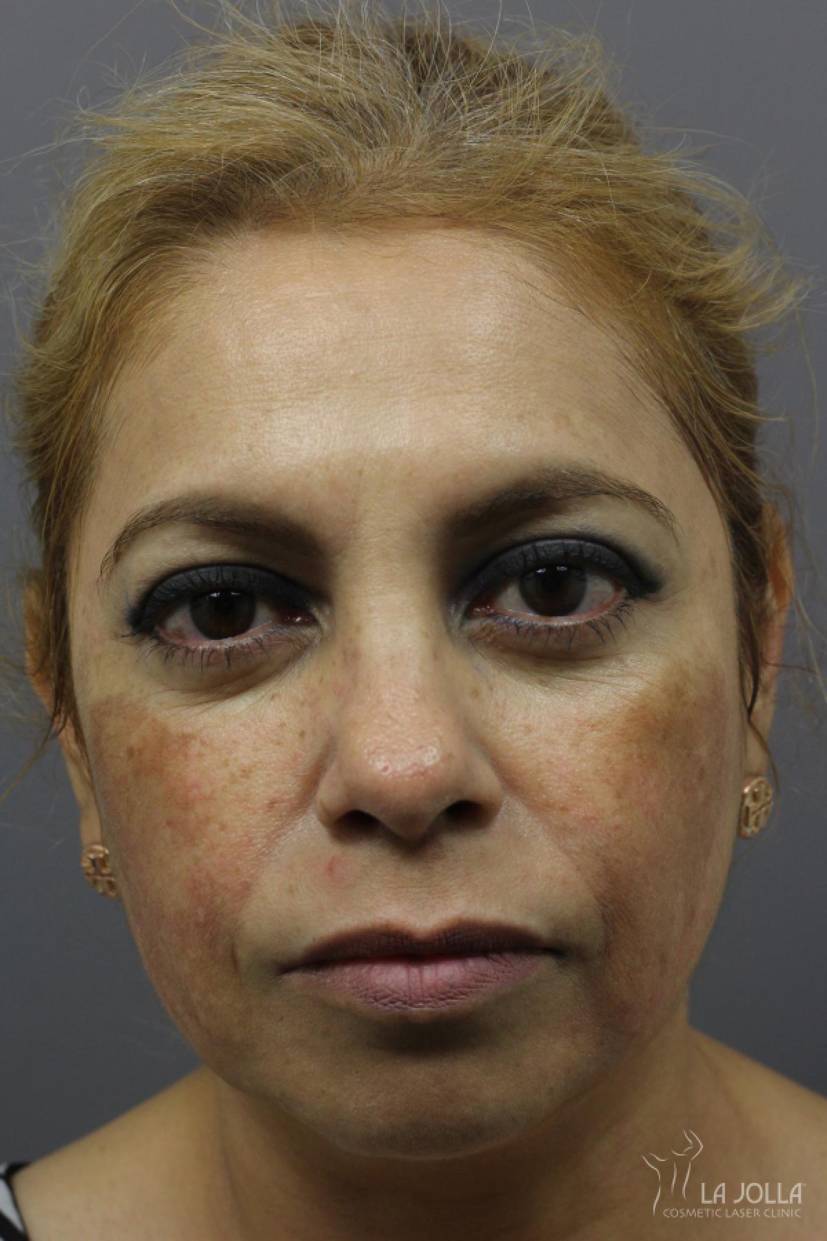 Chemical Peel: Patient 7 - Before 1