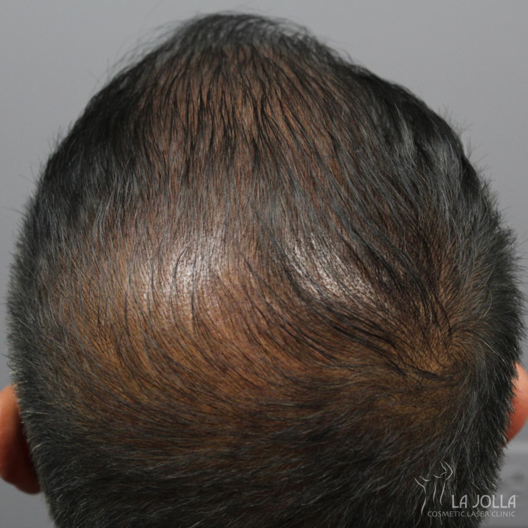 Hair Restoration: Patient 6 - After 1