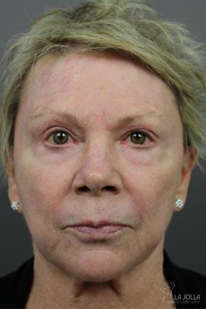 Liquid Facelift: Patient 6 - After  