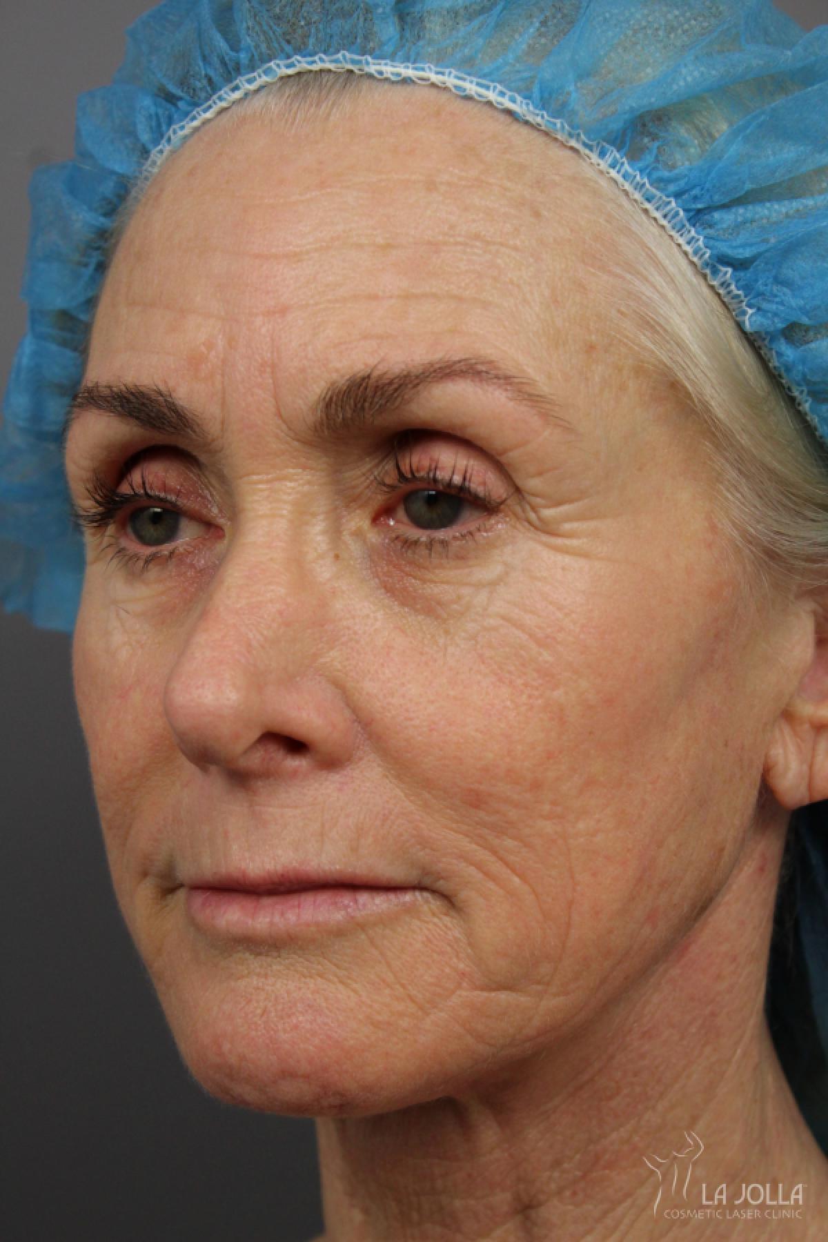 Laser Skin Resurfacing: Patient 1 - Before and After 3