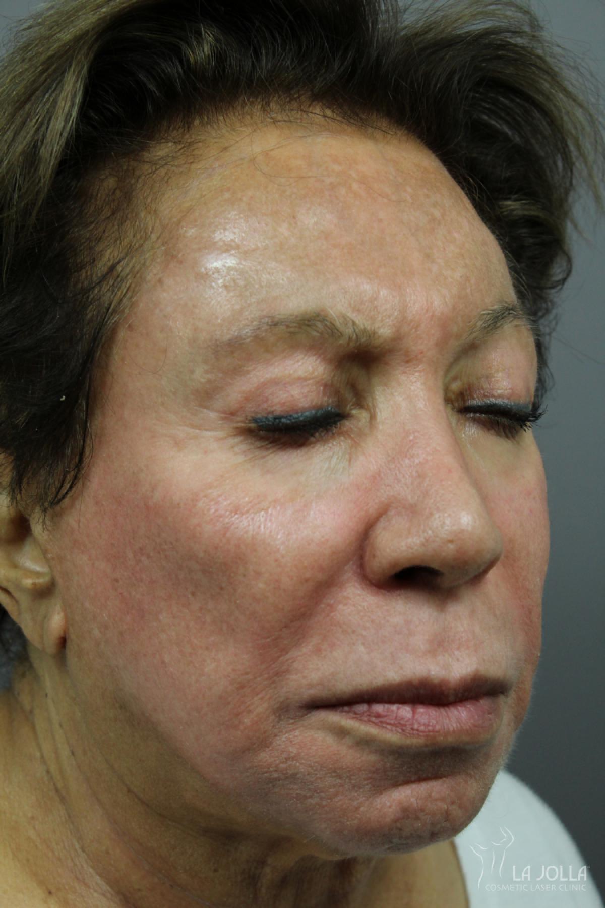 Chemical Peel: Patient 4 - After 1