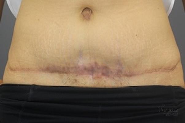 ResurFX: Patient 7 - After 1