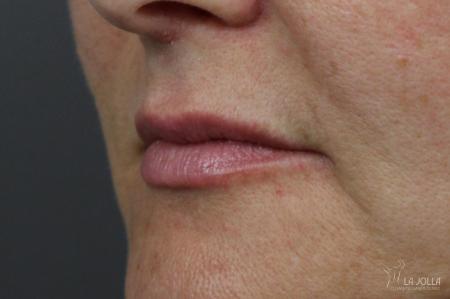 Juvéderm® XC: Patient 3 - Before 