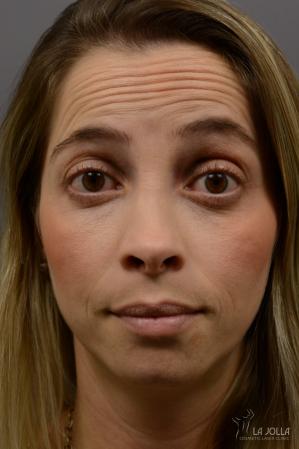 BOTOX® Cosmetic: Patient 1 - Before 
