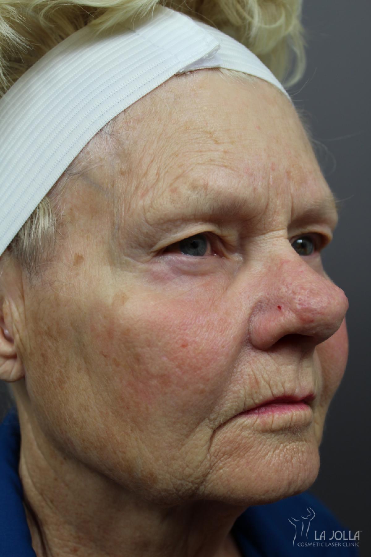 CO2 Laser: Patient 12 - Before 2