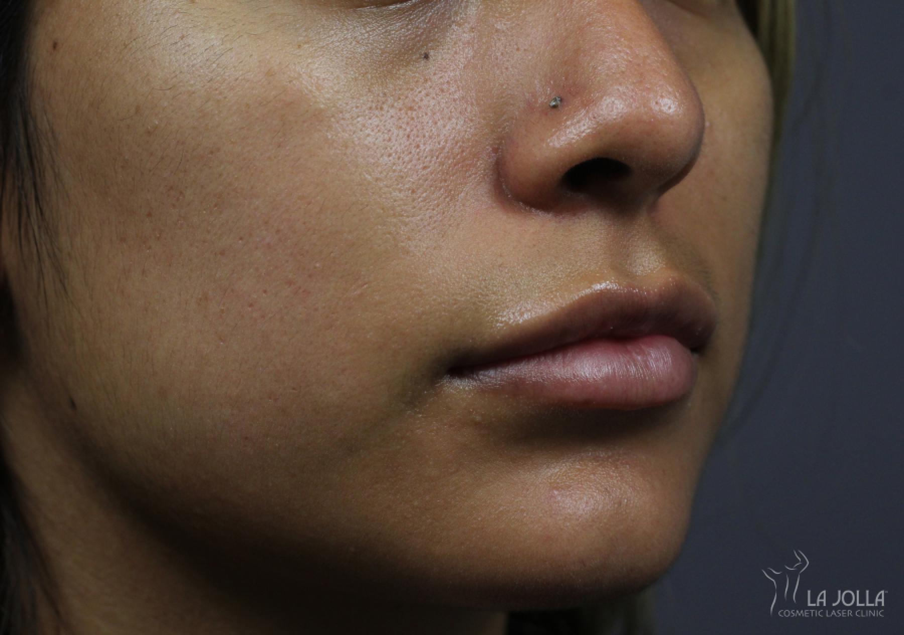 Lip Filler: Patient 12 - After 2