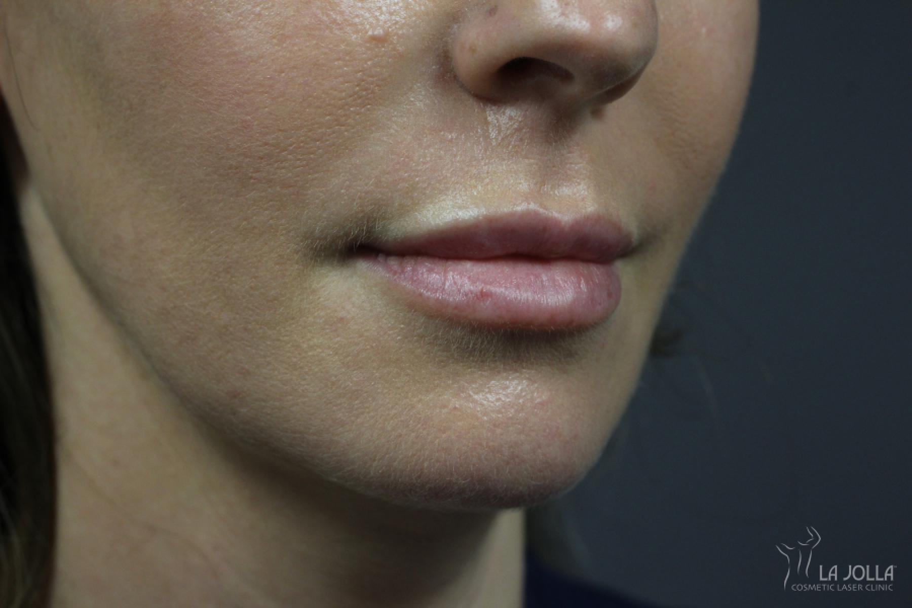 Lip Filler: Patient 11 - After 1