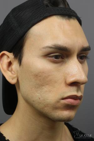 Acne Scars: Patient 7 - Before 