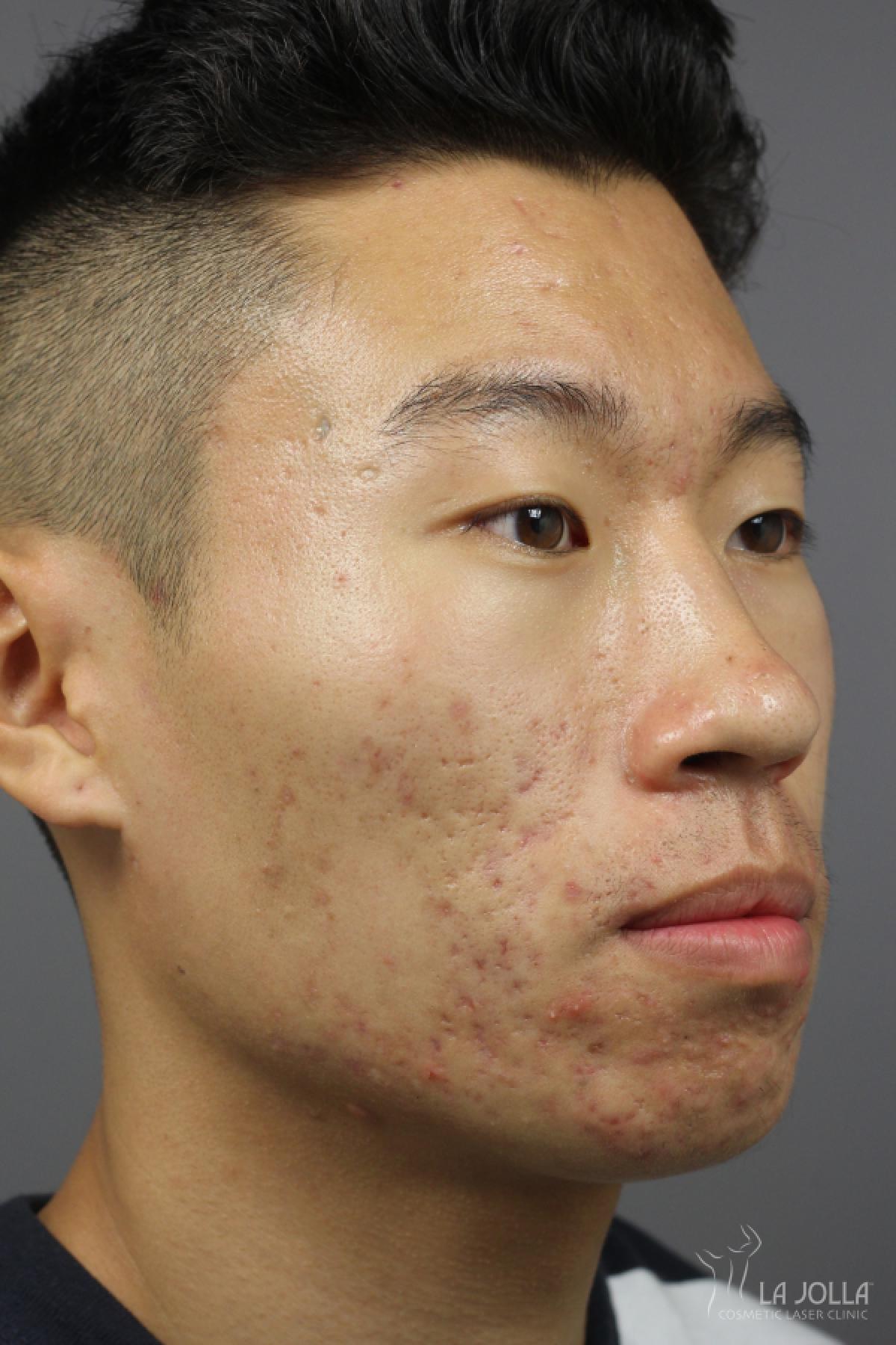 Acne Rejuvenation: Patient 1 - Before and After 2