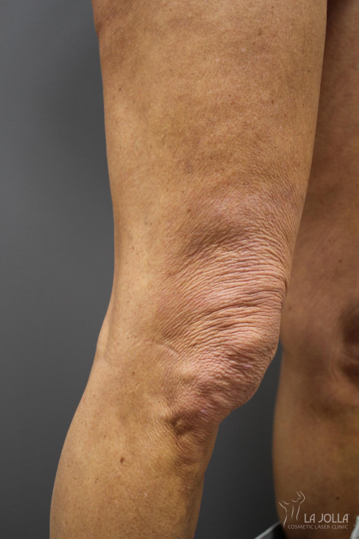 StarWalker® Laser: Patient 5 - Before 1