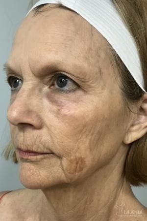 SP Dynamis: Patient 4 - Before 