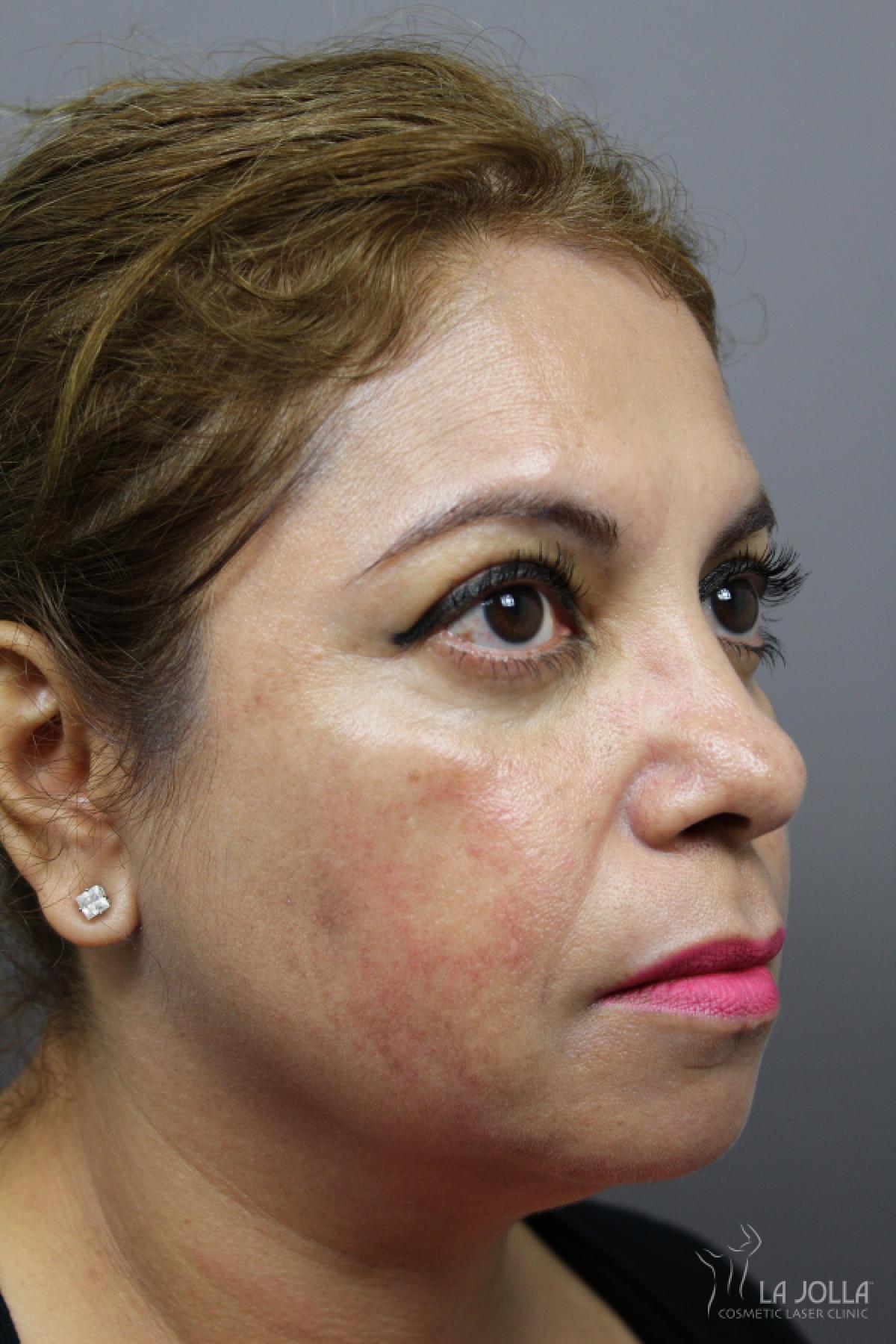 Chemical Peel: Patient 7 - After 2