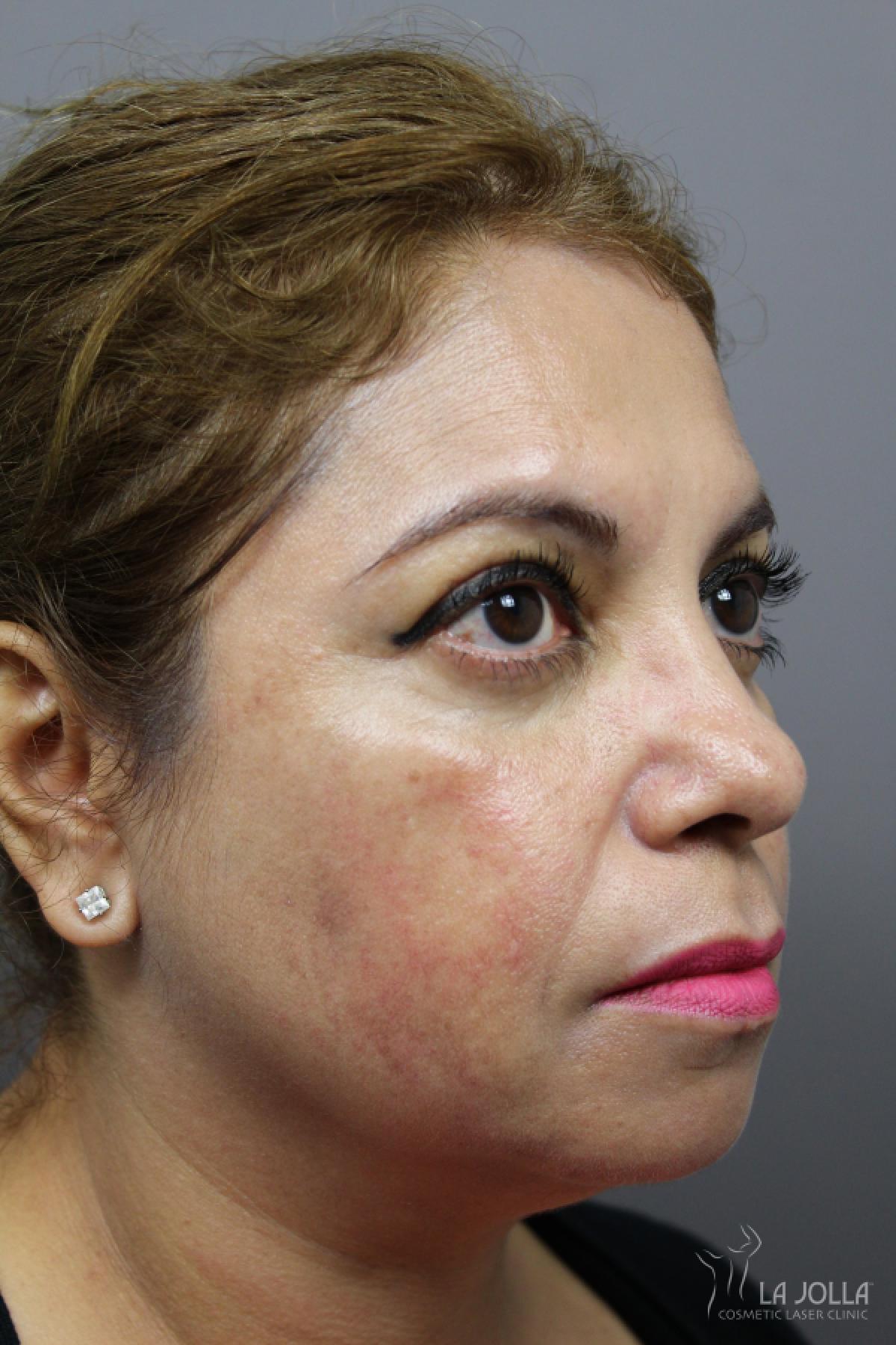 Chemical Peel: Patient 6 - After 2