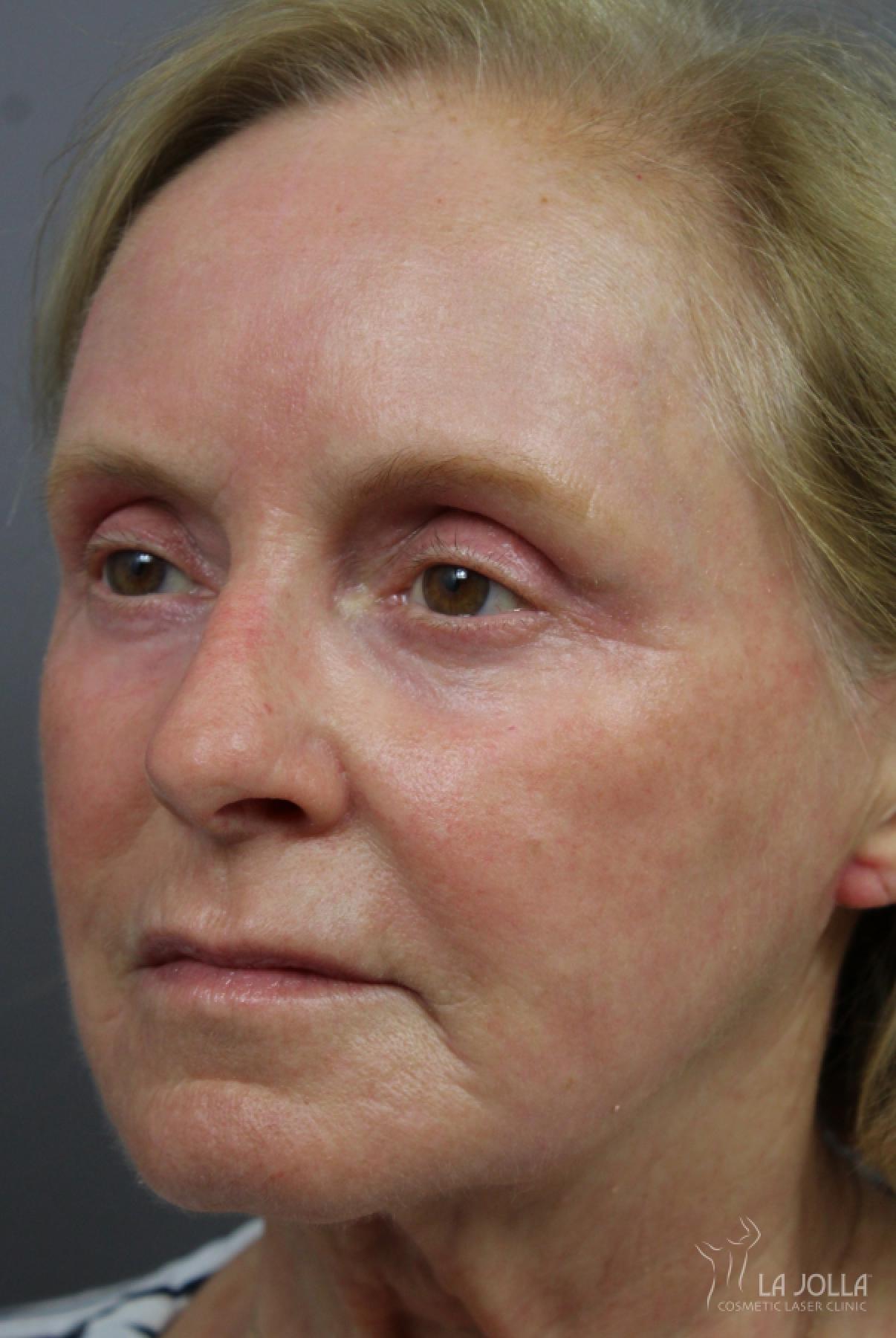 Laser Skin Resurfacing: Patient 2 - After 1
