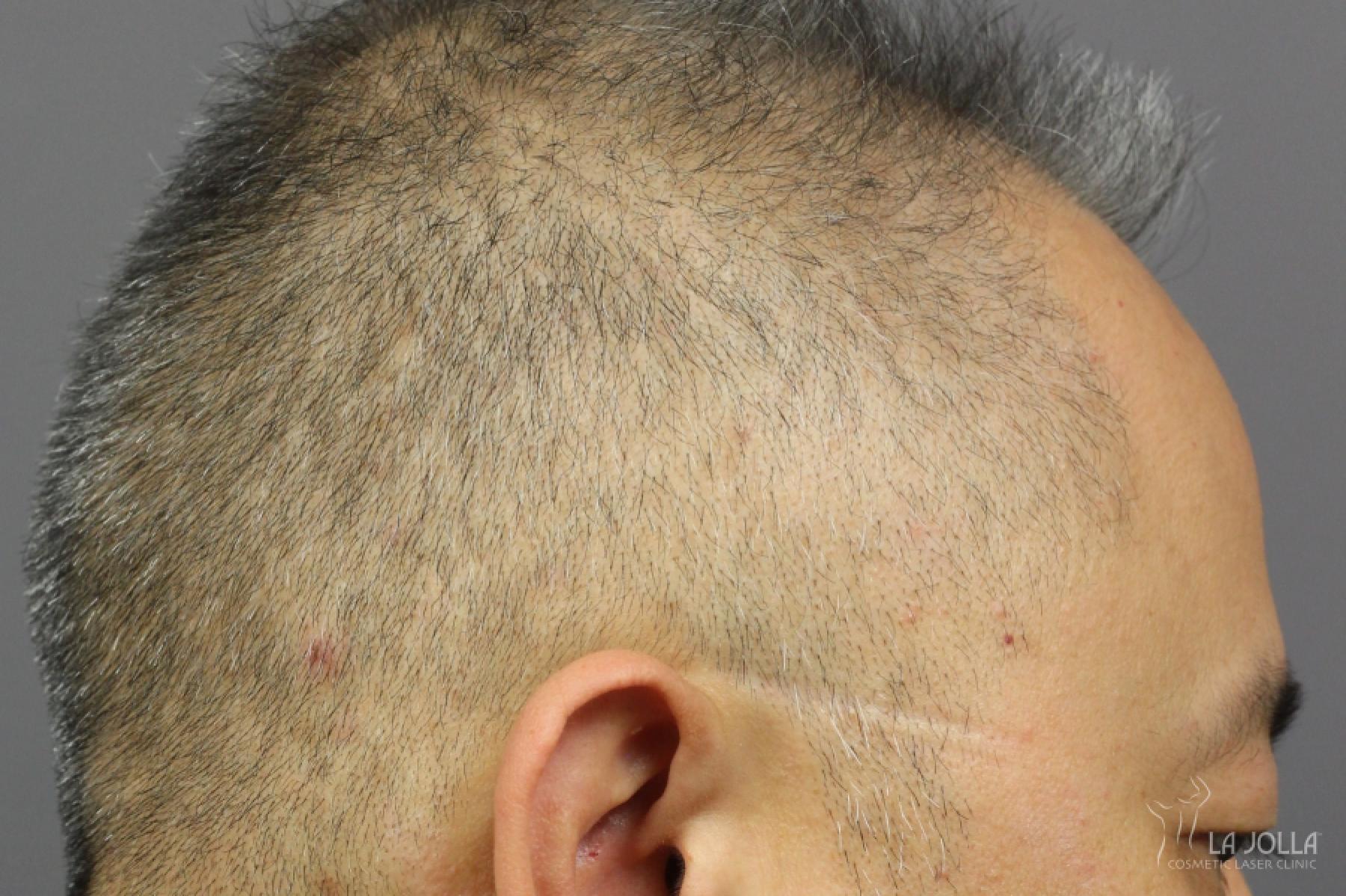 PRP (Platelet-Rich Plasma): Patient 3 - Before and After 3