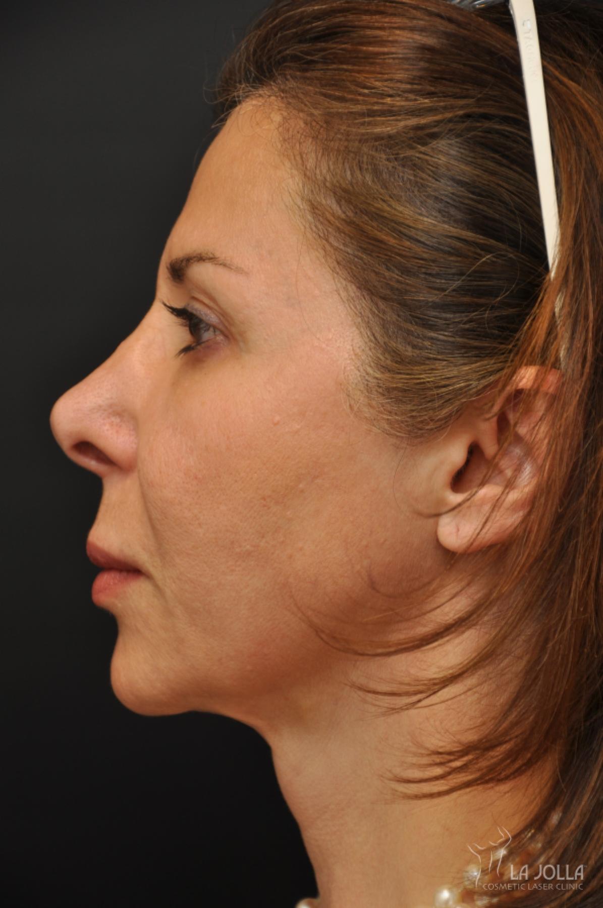 Ultherapy Patient 2 After Procedure
